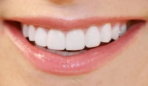 Teeth Whitening Giving you a Brigther Whiter Smile North Lakes