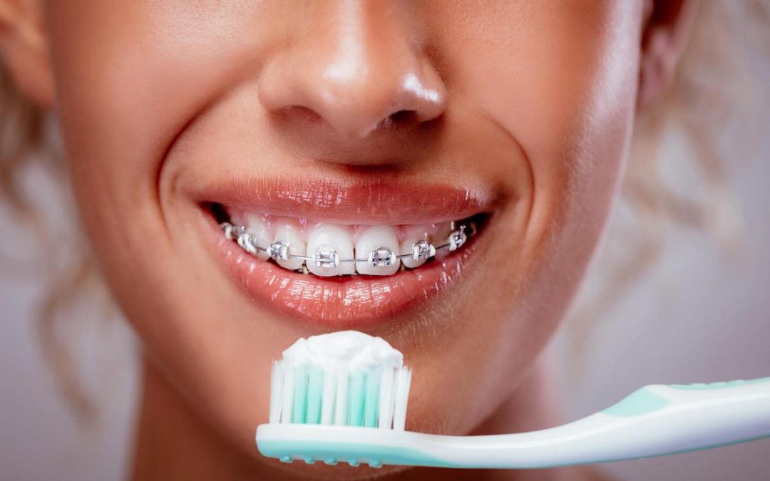 North Lakes Dentist Tips: How can I keep my teeth clean when wearing braces?