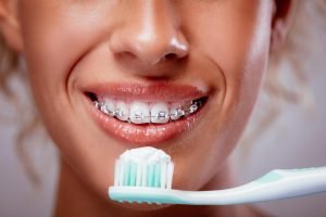 North Lakes Dentist Tips How can I keep my teeth clean when wearing braces