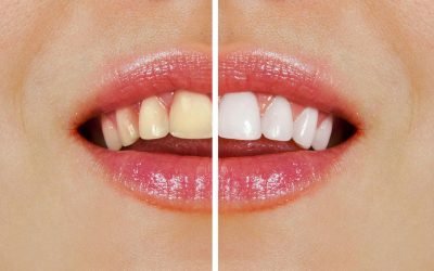 Over-the-Counter Whitening vs Professional Teeth Whitening – Which One Wins?