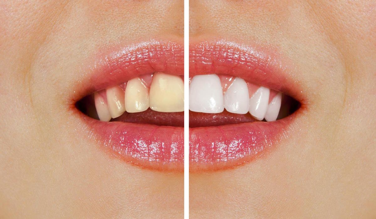 Over-the-Counter Whitening vs Professional Teeth Whitening Which One Wins North Lakes