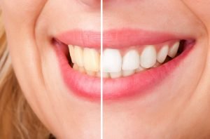 how to achieve a brighter smile north lakes