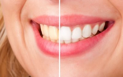 How to Achieve a Brighter Smile