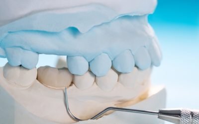 How Long Will Dental Crowns Last? Answers from Passion Family Dental North Lakes