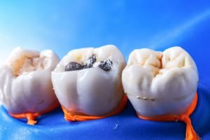 how to pick the right dental fillings in north lakes