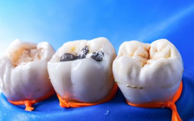 How to Pick the Right Dental Fillings in North Lakes