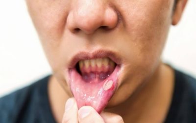 Mouth Ulcers: Causes, Treatment and When to See Your Dentist