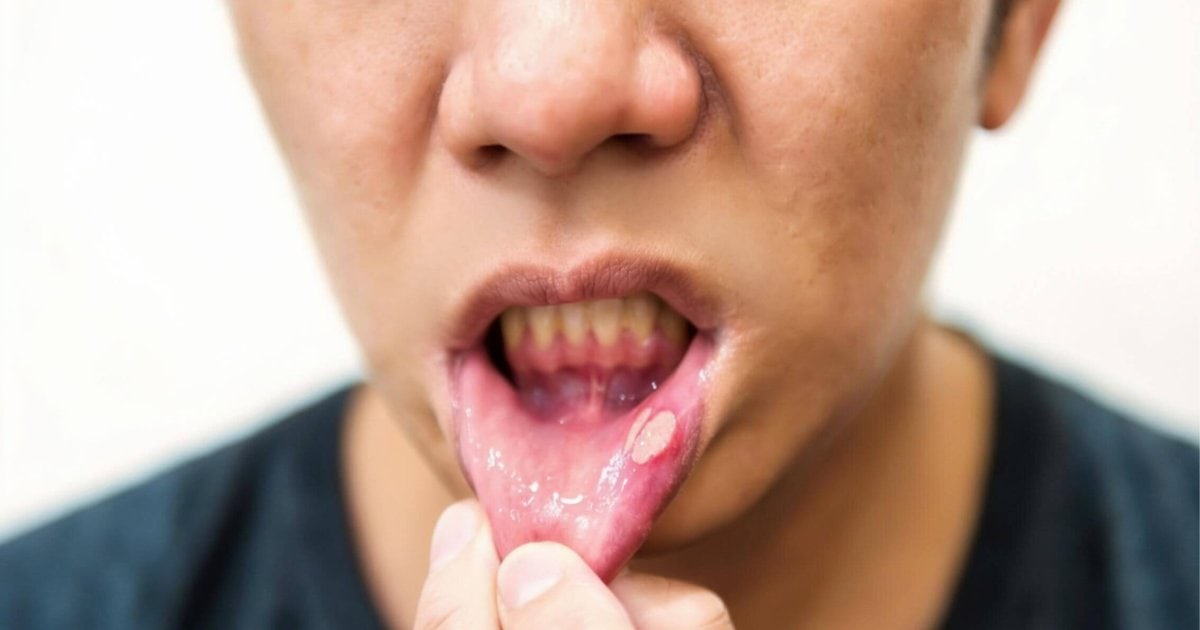 Close-up of a mouth ulcer on the inner cheek showing white centre and red border in North Lakes