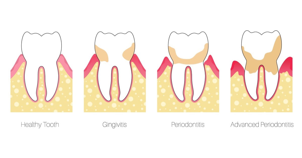 Diagram comparing a healthy tooth with gingivitis, periodontitis and advanced periodontitis in North Lakes